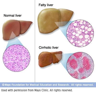 Liver Disease Risk Factors And Diagnostics - Canadian Liver Foundation