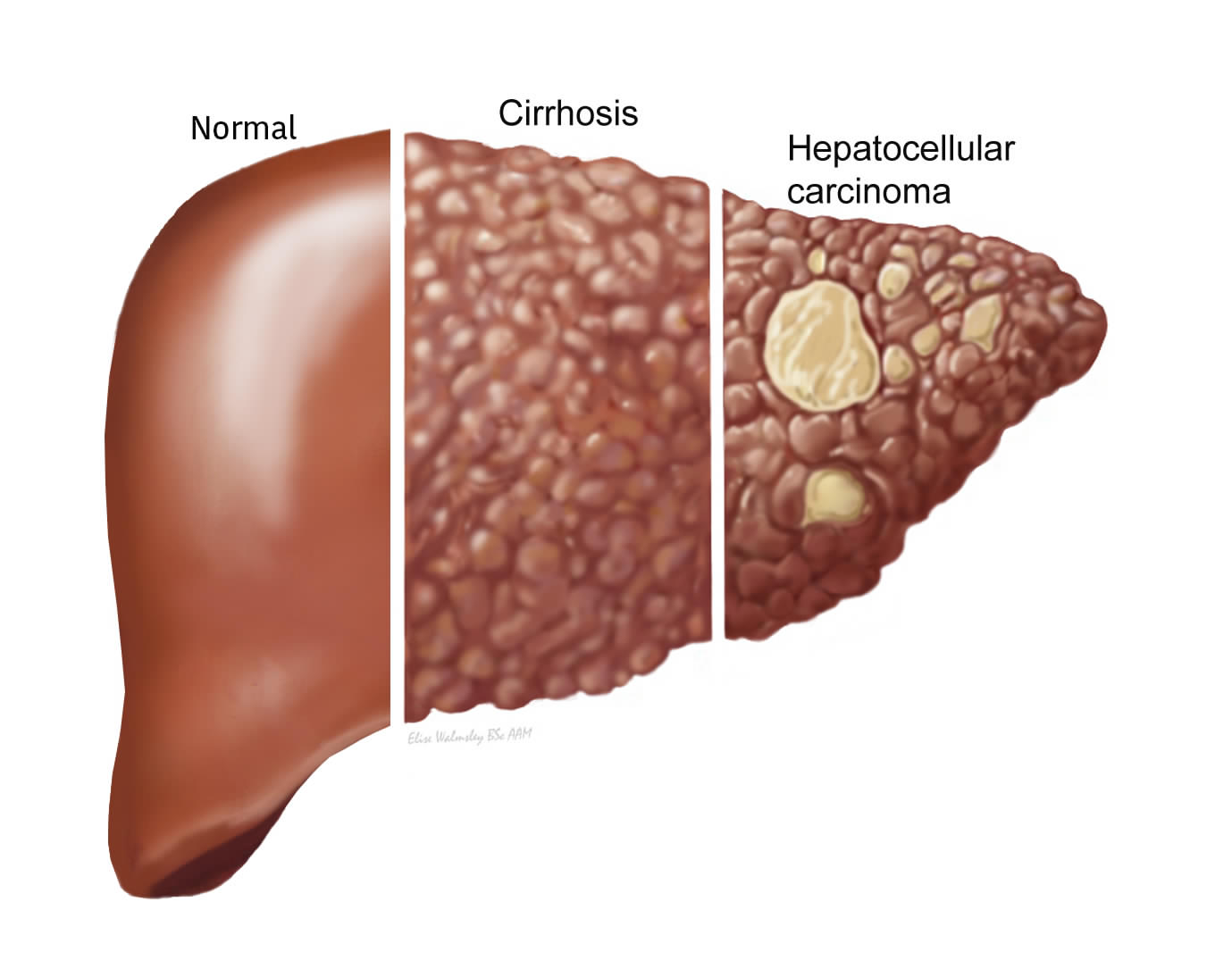 Hemochromatosis - Canadian Liver Foundation