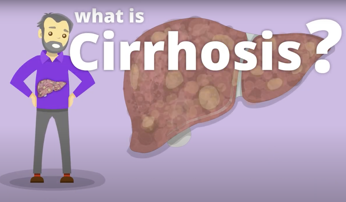 What is Cirrhosis? - Canadian Liver Foundation